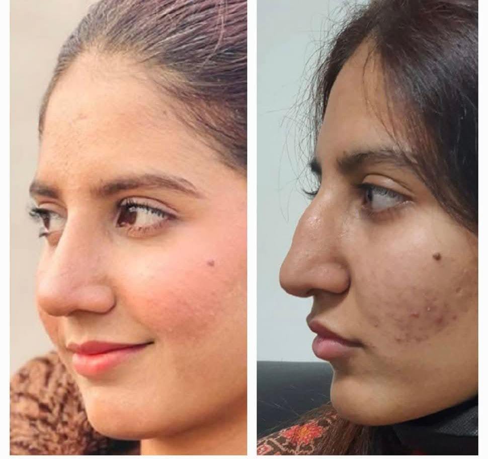Nose Defining Serum
